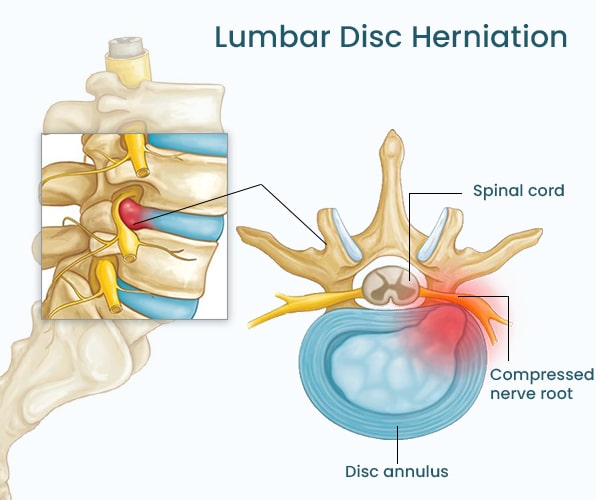 anatomy of lumbar disc herniation
