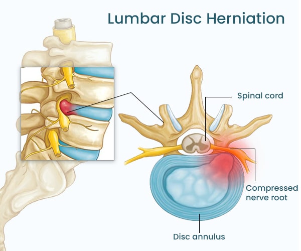 Disc Herniations Bulges Mandurah Chiropractor Massage Flex Health Professionals