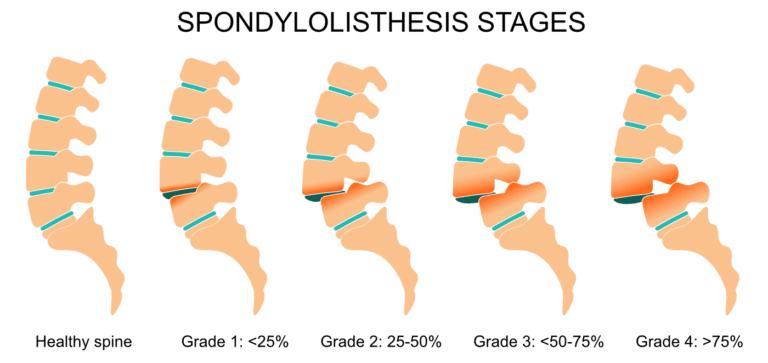 spondylolisthesis